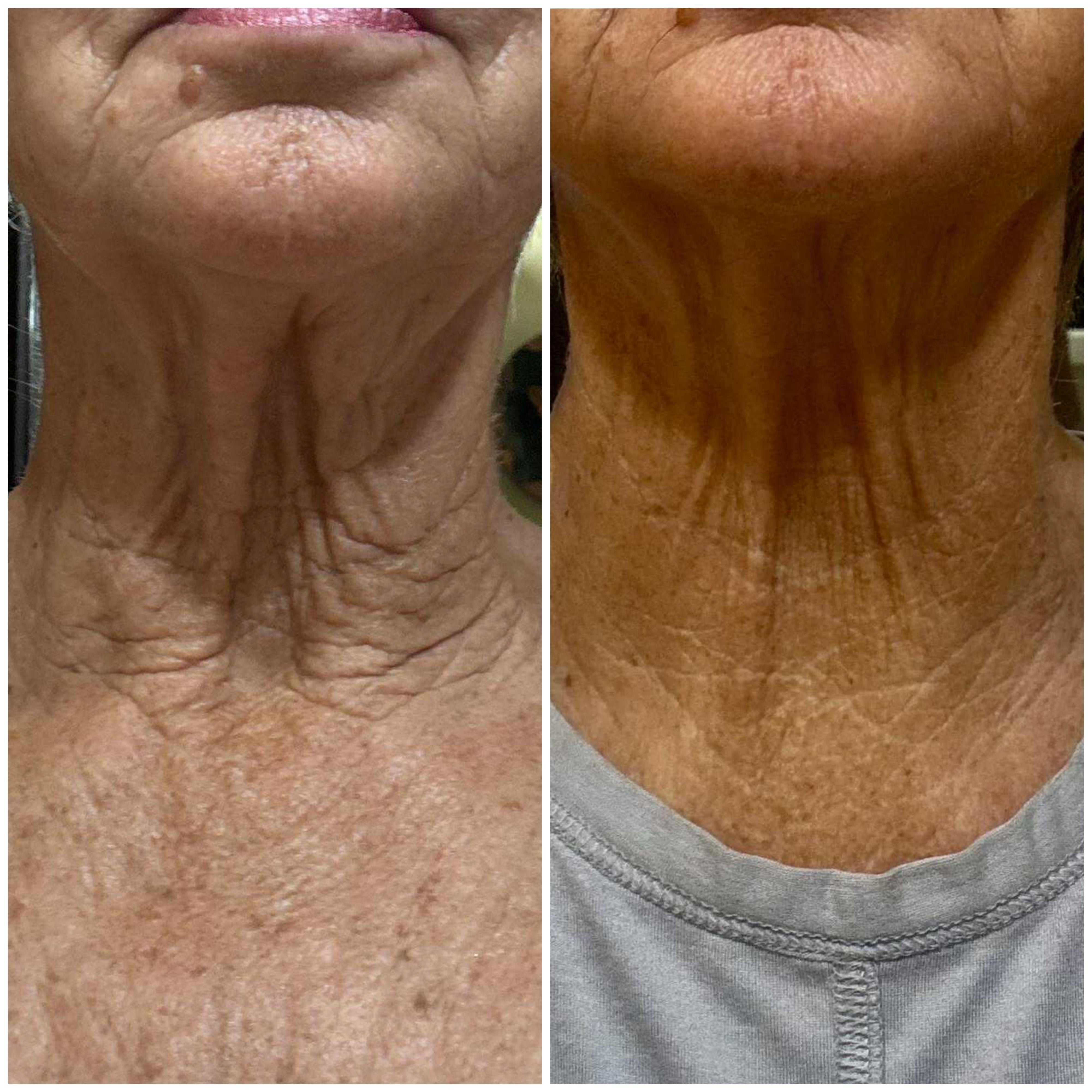 Neck Rejuvenation Ritual